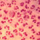 Gonococcal urethritis under the microscope. Image: Wikimedia